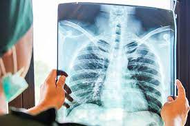 Más de la mitad de los casos por Enfermedad Pulmonar Obstructiva Crónica (EPOC), no logran diagnosticarse a tiempo
