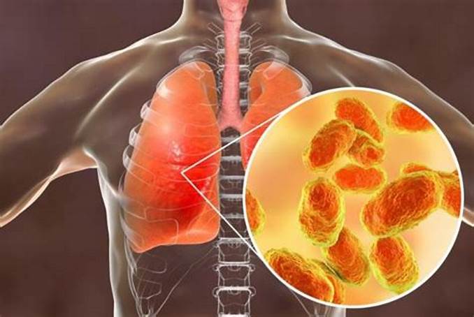 Neumonía: principal causa de muerte por infección en el mundo1 ¡Está en sus manos prevenirla!