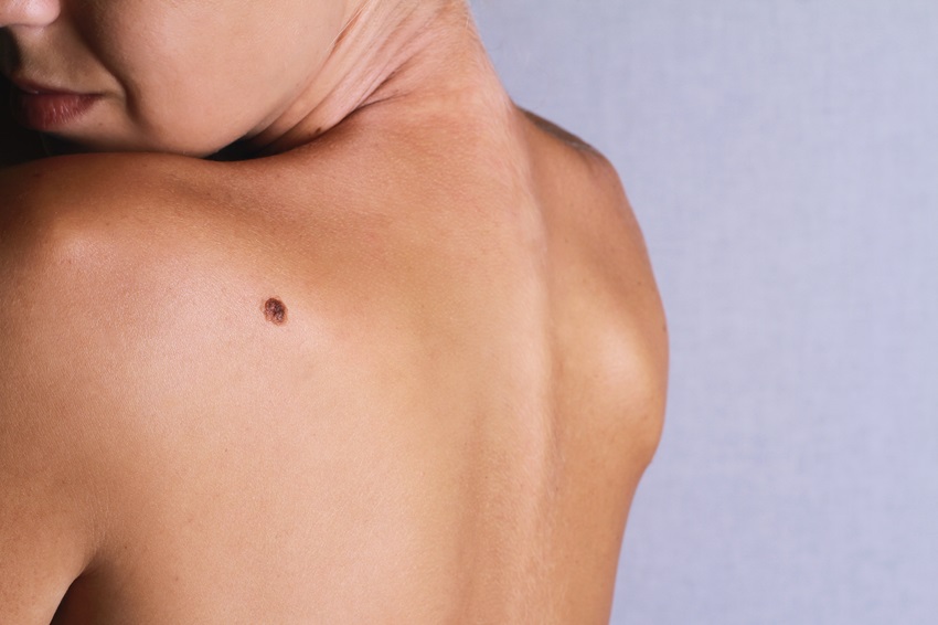 Aprueban inmunoterapia dual para mexicanos con melanoma avanzado