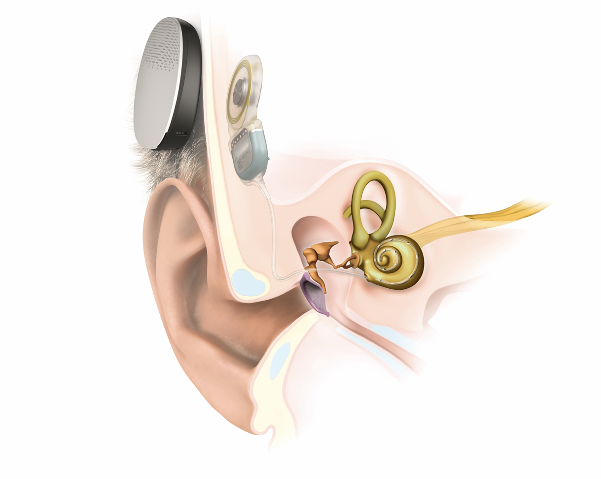 Implantes cocleares: ¿es posible recuperar la audición cuando todo parece silencio?